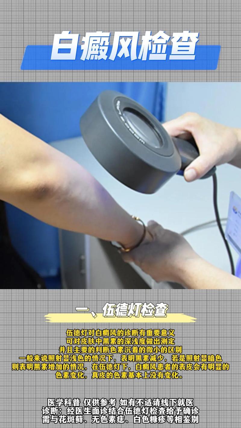 伍德灯检查有没有副作用